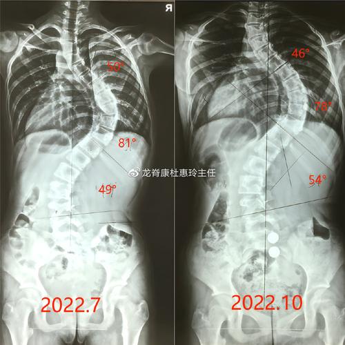 女孩脊柱侧弯80度;女孩脊柱侧弯80度严重吗