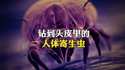 颅内寄生虫活8年;颅内寄生虫活8年会怎么样